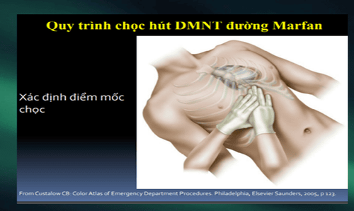 Ép tim cấp là gì? Các dấu hiệu nhận biết và điều trị