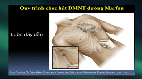 What is acute tamponade? Signs of recognition and treatment