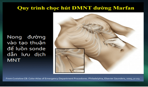 What is acute tamponade? Signs of recognition and treatment