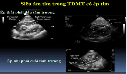 What is acute tamponade? Signs of recognition and treatment