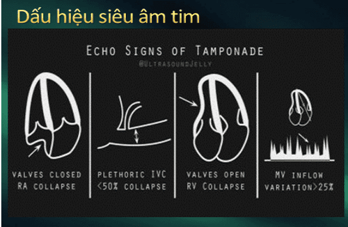 What is acute tamponade? Signs of recognition and treatment