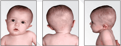 Detection and treatment of torticollis in children