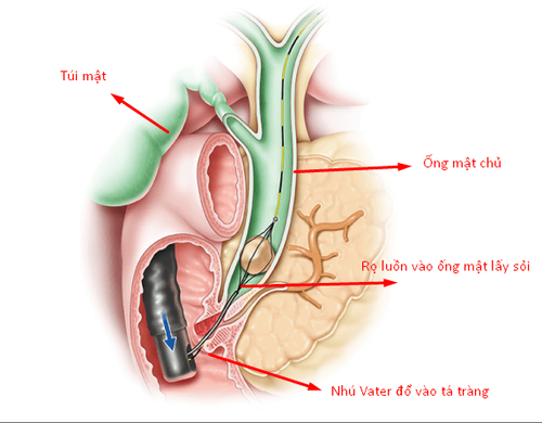 Endoscopic retrograde cholangiopancreatography - Information for patients