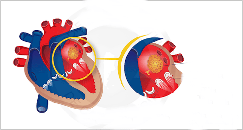 Overview of Atrial Myxoma