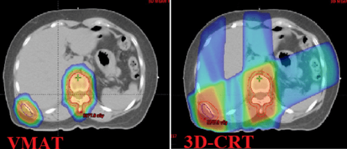 
Hình 4. So sánh kỹ thuật xạ trị VMAT và 3D-CRT cho di căn xương, VMAT giúp bảo vệ các cơ quan xung quanh tốt hơn rõ rệt so với 3D-CRT.
