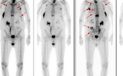 Radiation therapy for bone metastases