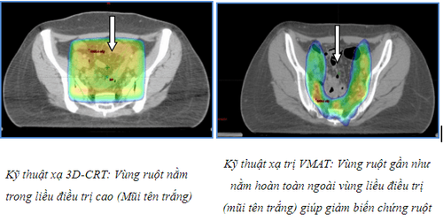 
Hình 4: So sánh kỹ thuật xạ trị thường quy 3D-CRT và kỹ thuật xạ trị cao VMAT
