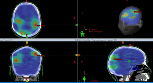 
Hình 4. Kỹ thuật xạ trị VMAT toàn não kết hợp tăng liều tới nhân di căn giúp tăng hiệu quả điều trị (kỹ thuật xạ thường quy 3D-CRT không làm được).
