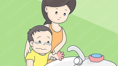 First aid steps for children with burns