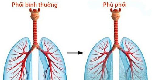 
Bé có dấu hiệu bị phù phổi cấp cần ngừng truyền dịch ngay
