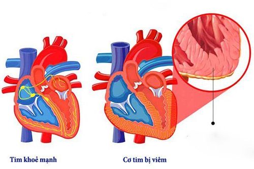 How to prevent myocarditis