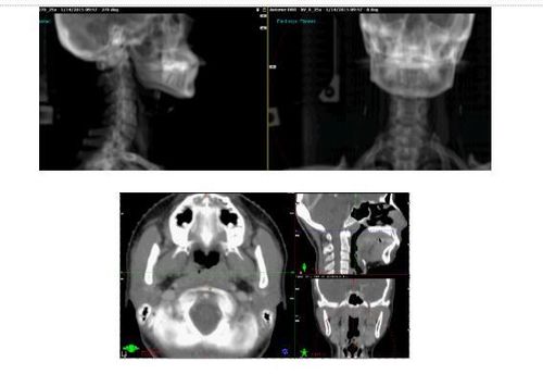 
Hình 4. Chụp xác minh X-quang 2 chiều và 3 chiều CBCT đảm bảo chiếu xạ đúng vị trí khối u cần xạ.
