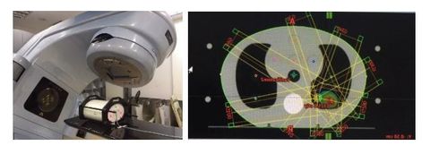 
Hình 6. Đo liều trên phantom kiểm tra chất lượng kế hoạch trước xạ trị.
