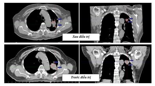 
Hình 8. Thể tích khối u phổi của bệnh nhân đã giảm đáng kể sau xạ trị SBRT, ban đầu kích thước 4,05cm x 2,93cm x 2.79cm, sau điều trị 9 tháng kích thước thu nhỏ còn 3.73cm x 2.21cm x 1.59cm (giảm 60,4% thể tích)
