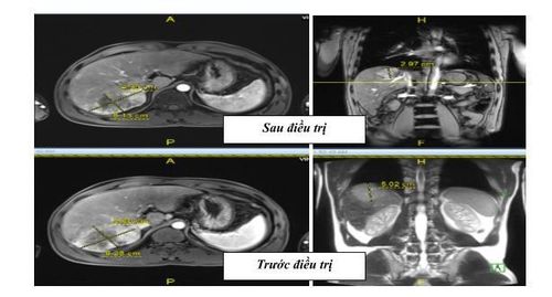 
Hình 9. Thể tích khối u gan của bệnh nhân đã giảm đáng kể sau xạ trị SBRT, ban đầu kích thước 5,6cm x 8,28cm x 5,02cm, sau điều trị 8 tuần kích thước thu nhỏ còn 4,39cm x 8,13cm x 2,97cm (giảm 54,5% thể tích).
