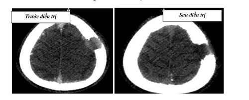 
Hình 10: BN Ung thư Gan di căn khối U xương sọ xâm lấn não và da đầu kt U ~ 20x27mm. sau 2 tháng điều trị khối U đã bay hoàn toàn , trên phim còn lại vùng khuyết xương
