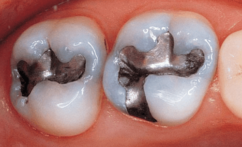 Can a broken tooth be filled with a filling?