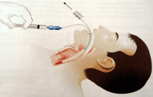 Anesthesia procedure for surgical laryngeal mask placement of brain positioning frames