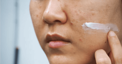 What is hormonal acne and how to treat it?