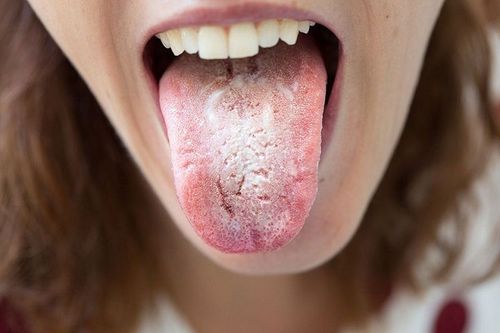 Candida infections of the mouth, throat and esophagus