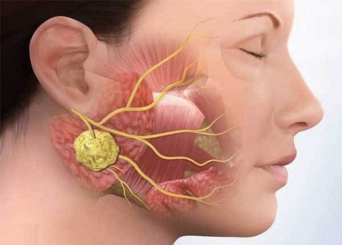 Parotid gland resection with or without preservation of the VIIth nerve