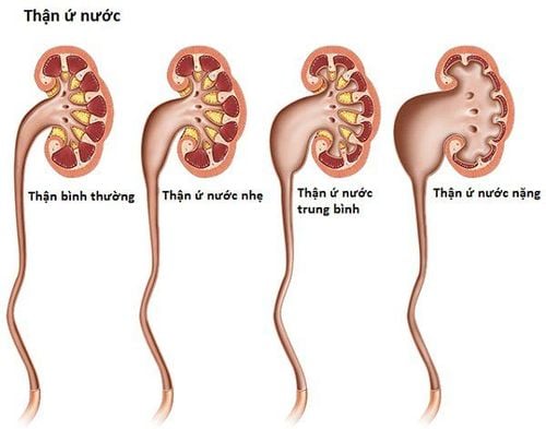 
Đặt sonde JJ được chỉ định trong trường hợp người bệnh bị tắc nghẽn tiết niệu
