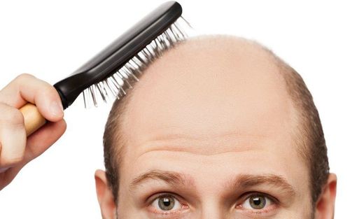 Male hair loss: Here's what to do