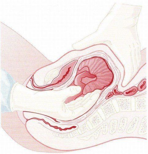 
Người bệnh được tiến hành khâu vết rách cổ tử cung âm đạo
