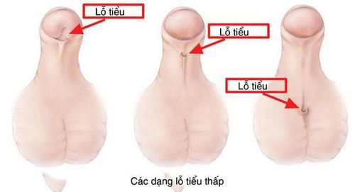 Endotracheal anesthesia for low deviation urinary tract surgery