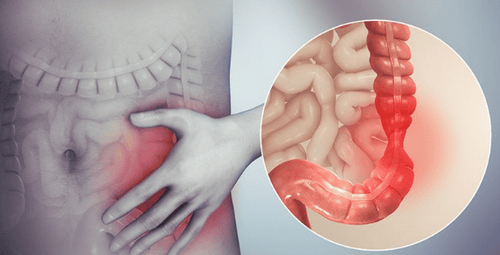 
Người bệnh cần kiểm soát stress nhằm giảm co thắt đại tràng
