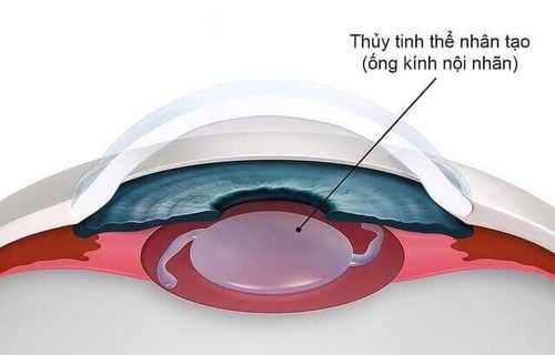 
Thủy tinh thể nhân tạo được ứng dụng trong điều trị một số bệnh lý về mắt
