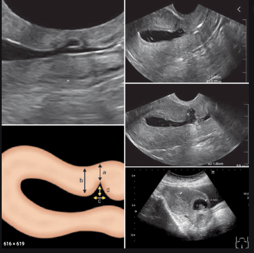 C-section scar defect - uterine fluid