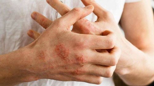 Có thể dùng thuốc điều trị viêm da cơ địa ở phụ nữ cho con bú?