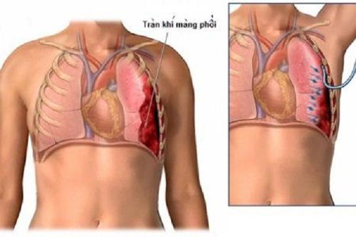 
Một trong tác dụng của chụp X quang viêm phổi là đưa ra chẩn đoản tình trạng tràn dịch hoặc tràn khí màng phổi
