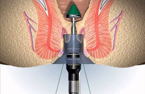 Mổ trĩ bằng phương pháp longo, đi đại tiện thường đau rát hậu môn có sao không?