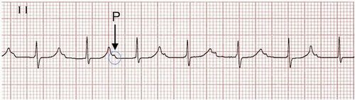 
Block nhĩ thất rõ ràng (khoảng PR > 300 ms, sóng P được ẩn trong các sóng T trước).
