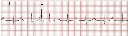 
ECG cho thấy hình ảnh Block nhĩ thất độ I (Block nhĩ thất rõ ràng (khoảng PR > 300 ms, sóng P được ẩn trong các sóng T trước))
