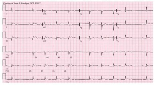 
ECG Block nhĩ thất độ 2 - Mobitz I
