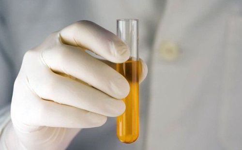 Cơ thể mất nước khiến nước tiểu đậm màu ở một số nam giới