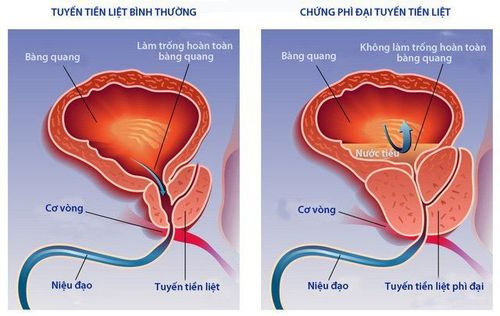 Common imaging tests and diagnostic tests for benign prostatic hypertrophy