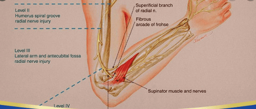 Symptoms of brachial plexus inflammation