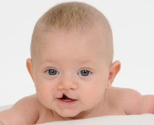 Trẻ hở vòm họng phần mềm có gặp khó khăn trong bú bình không?