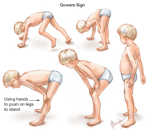 Types of muscular dystrophy and causes