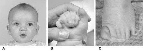 
Hội chứng Greig cephalo polysyndactyly với bất thường ở bàn tay và chân
