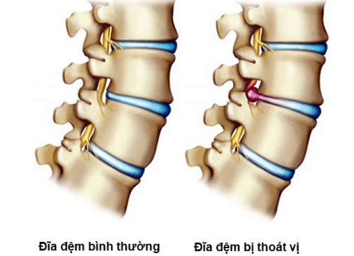 
Thoát vị đĩa đệm xảy ra khi nhân nhầy của đĩa đệm bị thoát khỏi vị trí thông thường, gây ra chèn ép vào các dây thần kinh.
