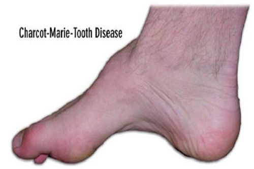 Causes of Charcot-Marie-Tooth disease (atrophy of the peroneal muscle)