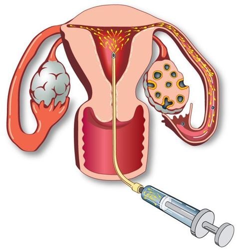 Abstaining from sexual intercourse before sperm injection can increase the chances of getting pregnant.