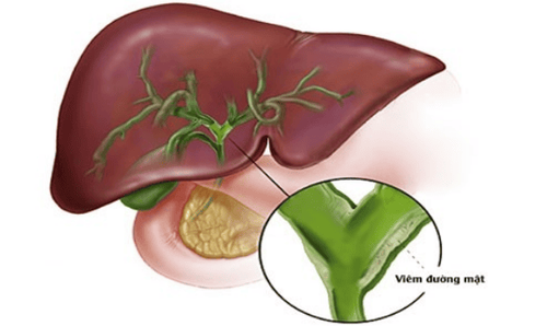 What is primary cholangitis?