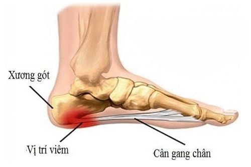 
Viêm cân gan chân khiến người bệnh đi lại khó khăn
