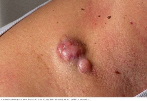 
Hình ảnh của bệnh Dermatofibrosarcoma protuberans (DFSP)
